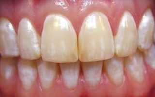 6 предостережений для тех, кто хочет провести фторирование зубов дома