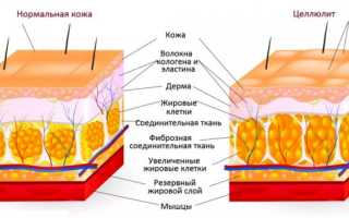 Целлюлит – страшная болезнь или норма? Когда возникает и как избавиться?