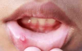 Что делать, если на губе или лице часто появляется герпес: процесс заживления, лечения и профилактики