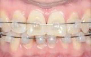 Фальшивые брекеты ― стоит ли такая красота жертв