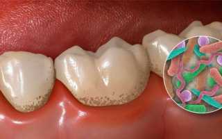 Средства для лечения кариеса у детей