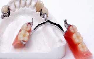 Что такое перебазировка съемного протеза